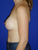 Breast Augmentation