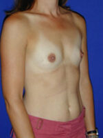 Breast Augmentation