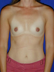 Breast Augmentation