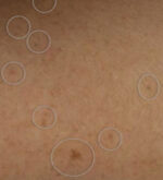 Brown Spots, Wart and Scar Removal