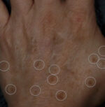 Brown Spots, Wart and Scar Removal