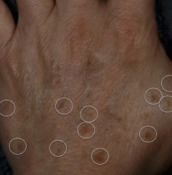 Brown Spots, Wart and Scar Removal