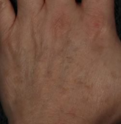 Brown Spots, Wart and Scar Removal