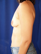 Breast Augmentation