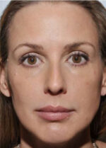 Sculptra
