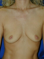 Breast Augmentation