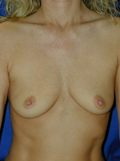 Breast Augmentation