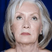 Facelift