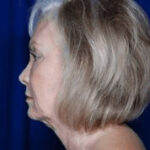 Facelift