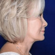 Facelift