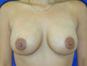 Breast Augmentation