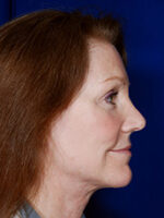 Facelift