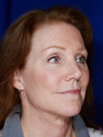 Facelift