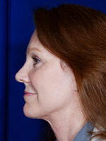 Facelift