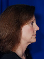 Facelift