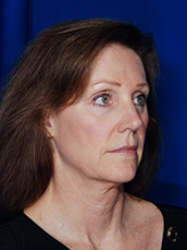 Facelift