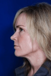 Facelift