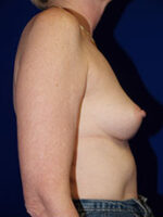 Breast Augmentation