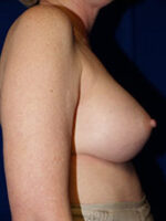 Breast Augmentation