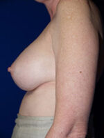 Breast Augmentation