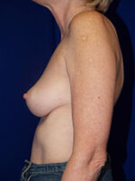 Breast Augmentation