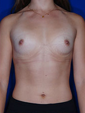 Breast Augmentation