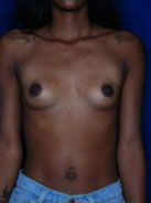 Breast Augmentation