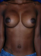 Breast Augmentation