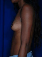 Breast Augmentation