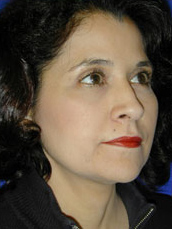 Facelift
