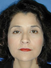 Facelift
