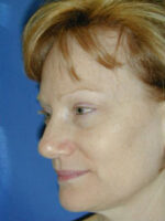 Facelift