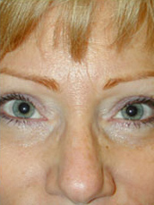 Facelift