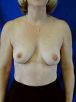 Breast Augmentation