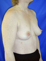 Breast Augmentation