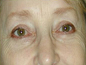 Facelift