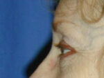 Facelift