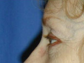 Facelift