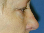 Facelift