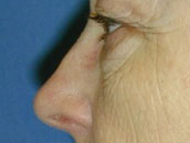 Facelift