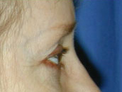 Facelift