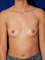 Breast Augmentation