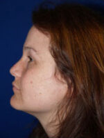 Facelift