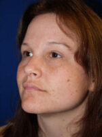 Facelift