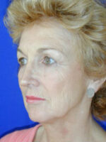 Facelift