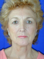 Facelift
