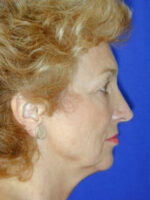 Facelift