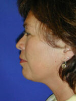Facelift
