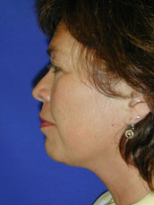 Facelift