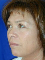 Facelift
